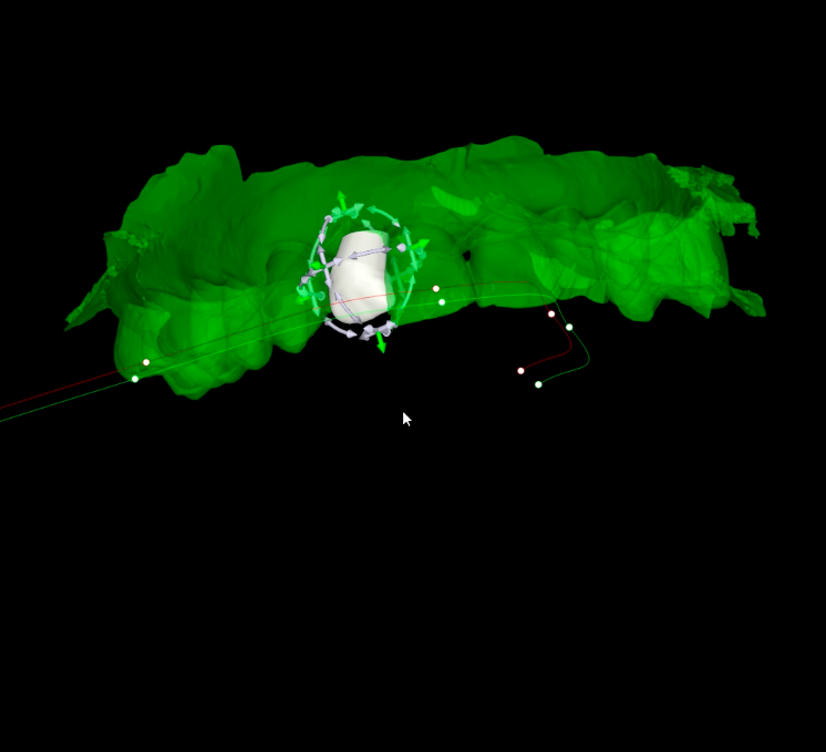 Cirugía guiada de implantes dentales en Laooal Dental