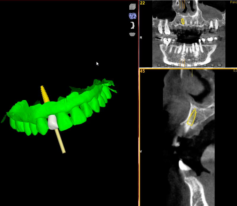 Cirugía guiada para implantes dentales en Las Palmas de Gran Canaria