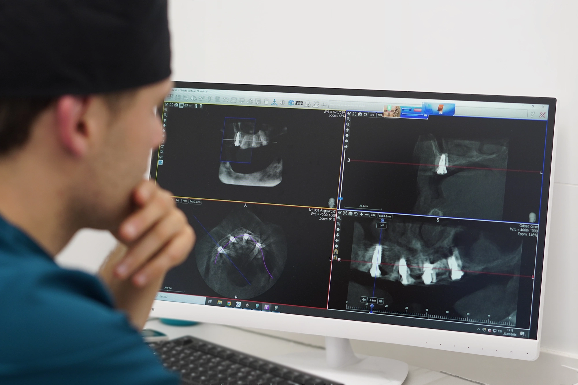 Implantes dentales en Las Palmas de Gran Canaria - Laooal Dental